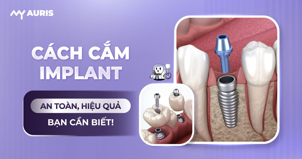 cách cắm implant