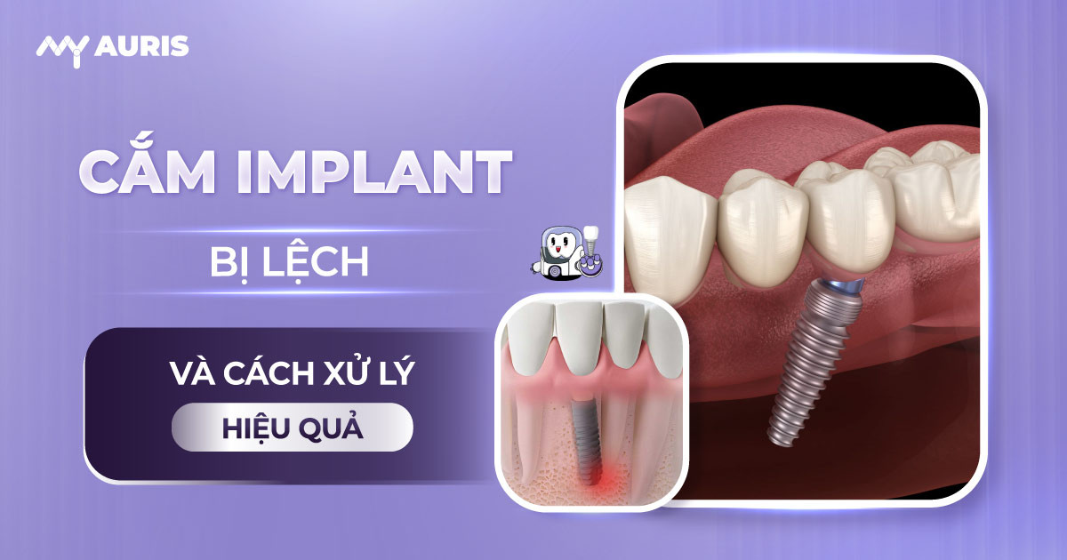 cắm implant bị lệch