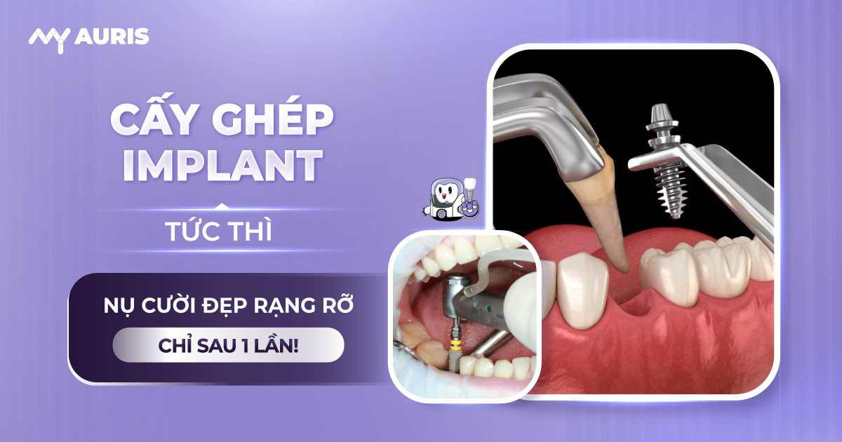 cấy ghép implant tức thì