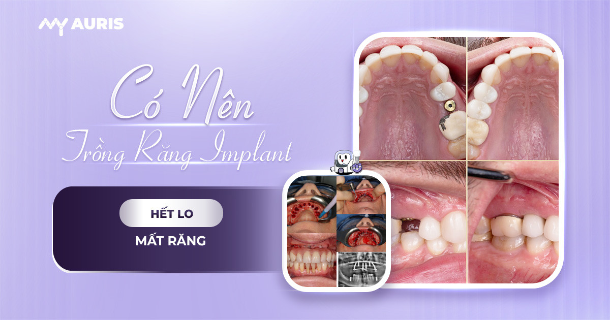 có nên trồng răng implant không,có nên cắm implant,có nên trồng răng implant