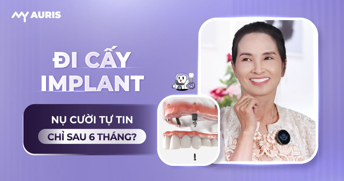 đi cấy implant