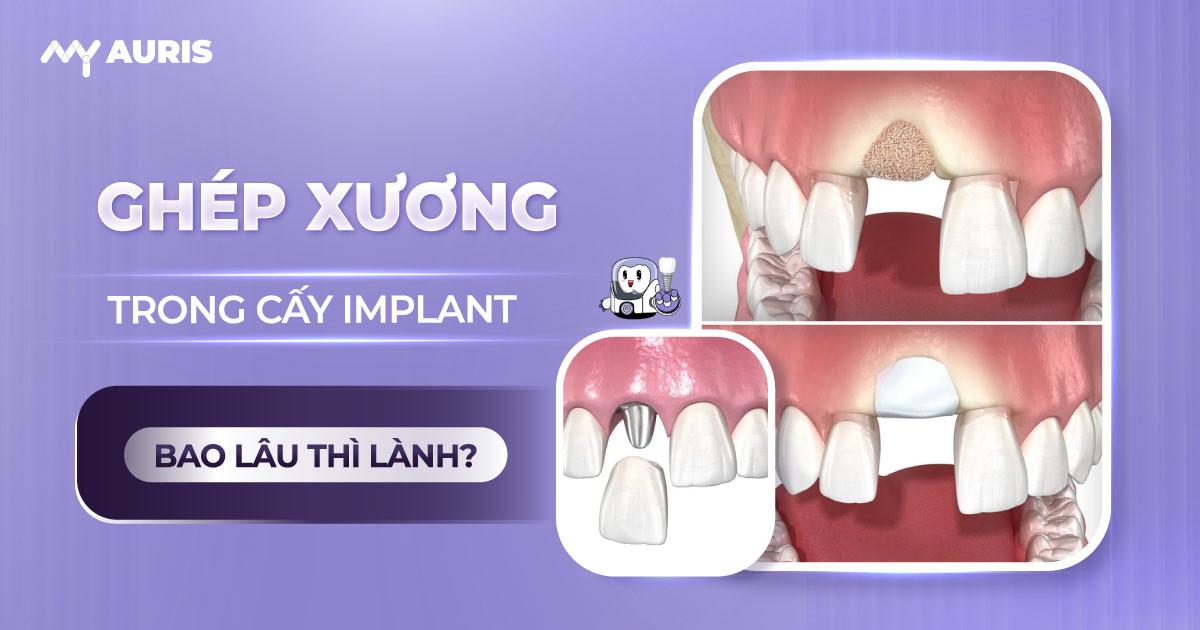 ghép xương trong cấy implant bao lâu