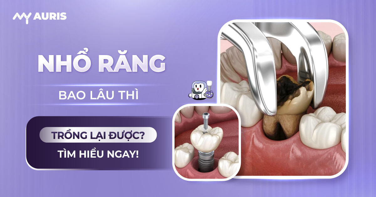 nhổ răng bao lâu thì trồng lại được