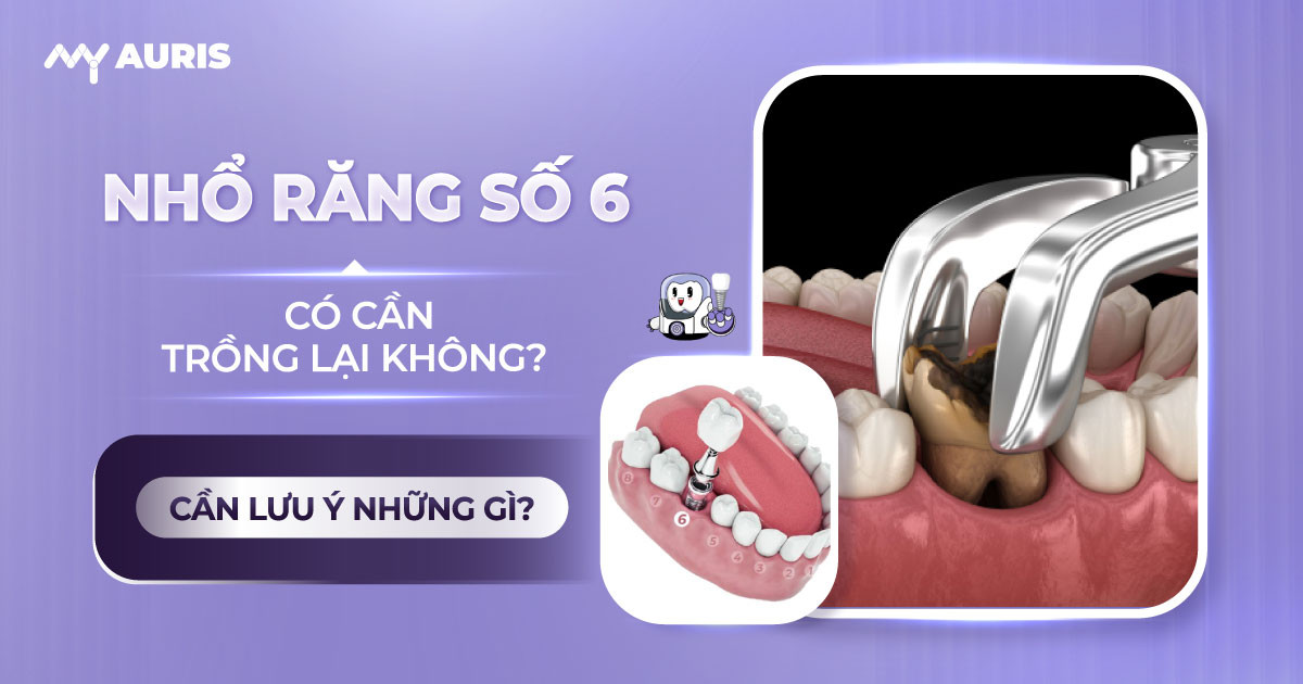 nhổ răng số 6 có cần trồng lại