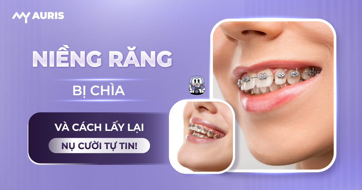 niềng răng bị chìa