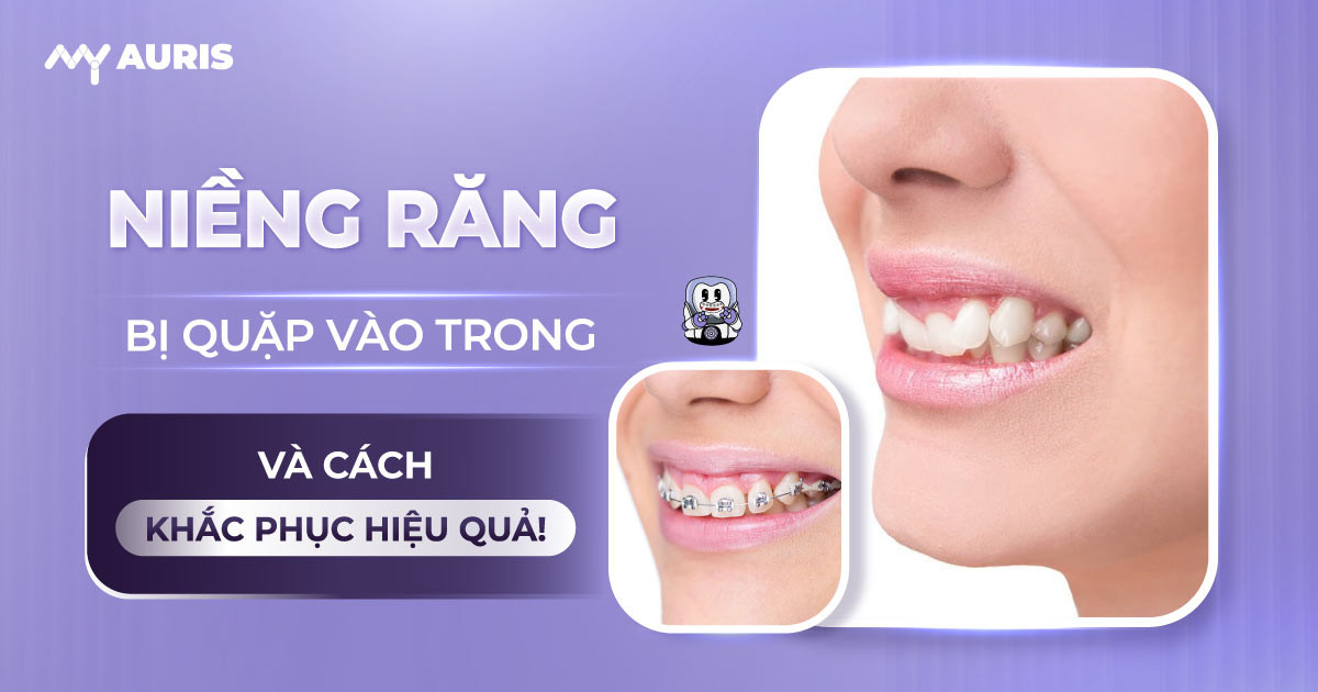 niềng răng bị quặp vào trong