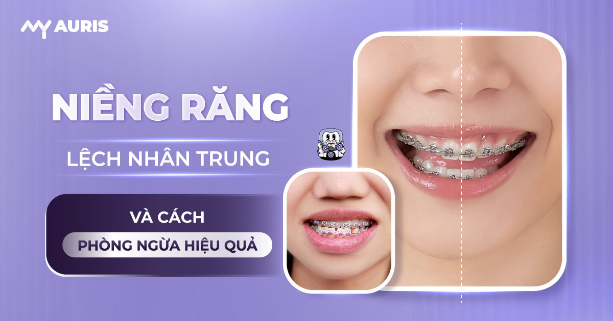 niềng răng lệch nhân trung