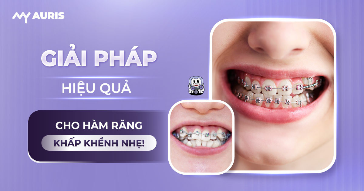 răng khấp khểnh nhẹ