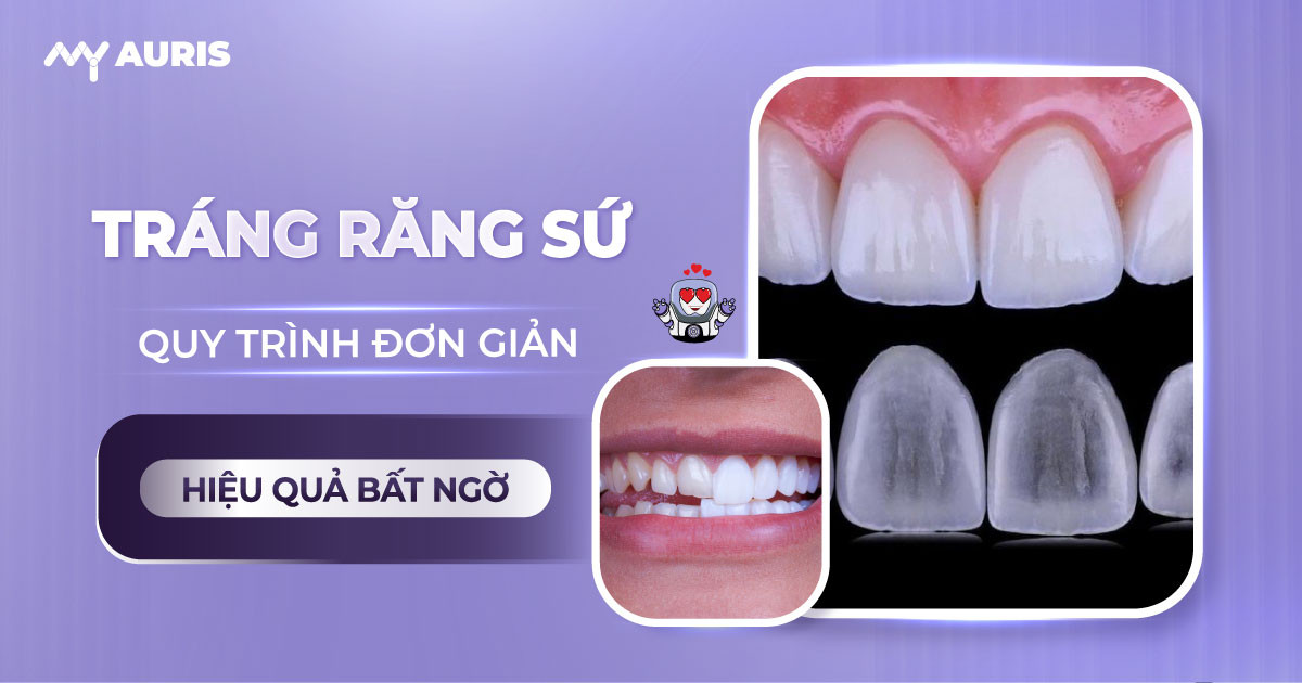 tráng răng sứ