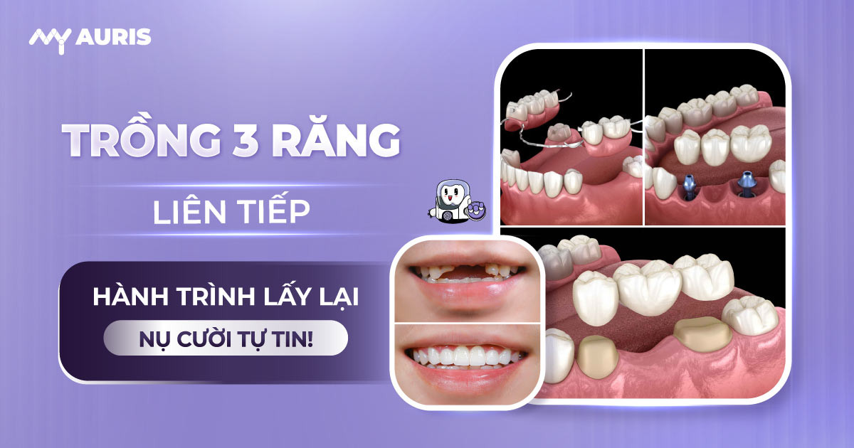 trồng 3 răng liên tiếp