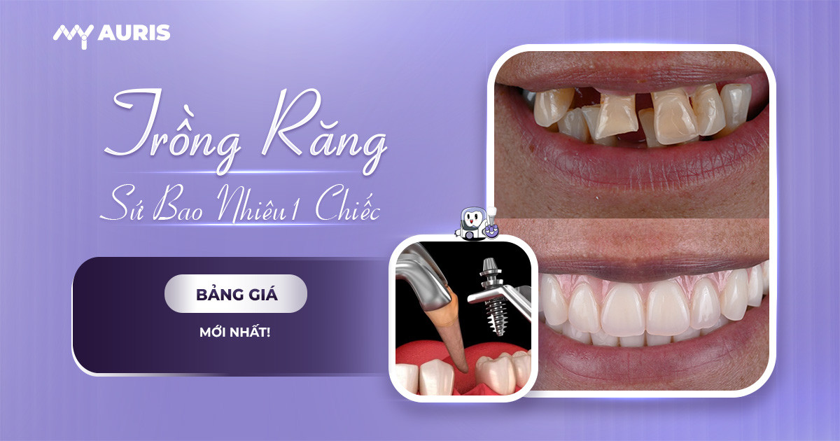 Trồng Răng Sứ Giá Bao Nhiêu 1 Chiếc