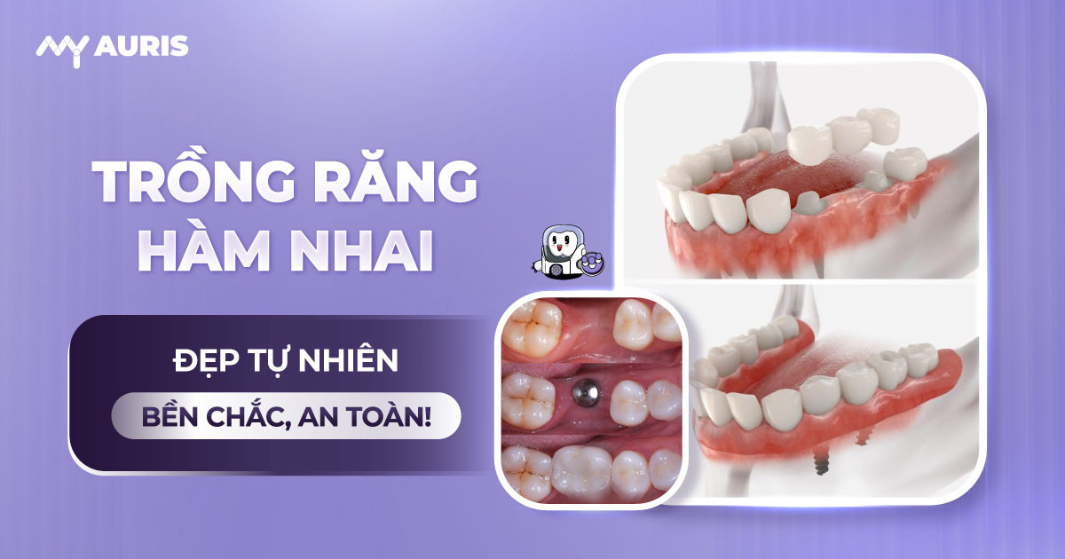 trồng răng hàm nhai