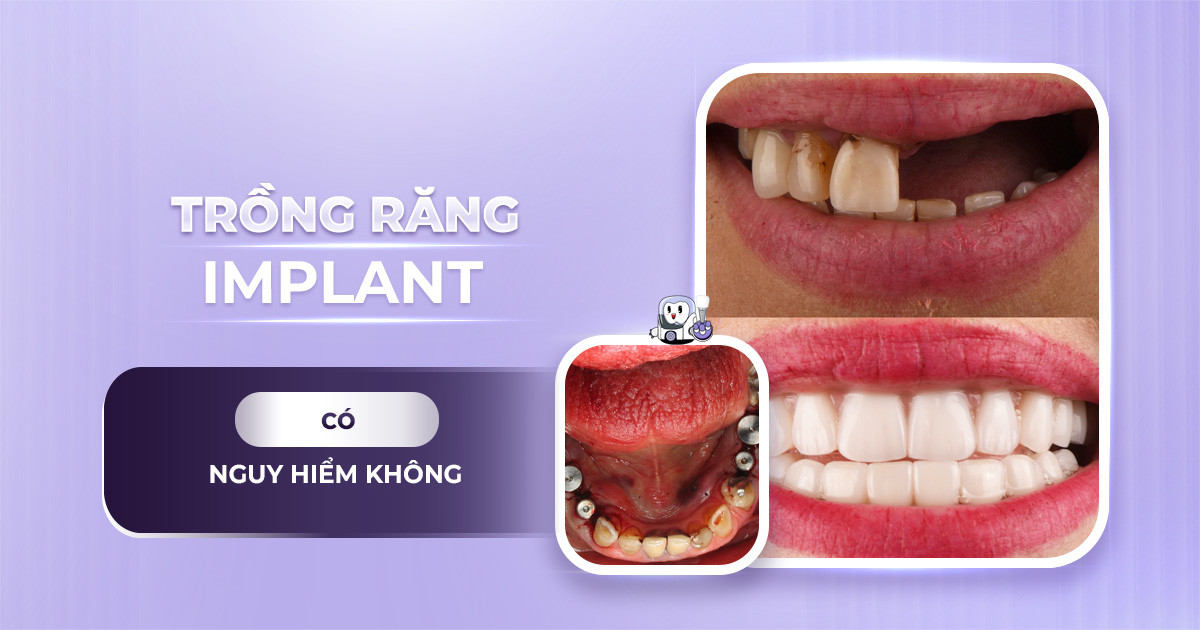 trong-rang-implant-co-nguy-hiem-khong-221124-01