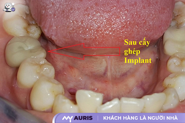 Trồng răng implant ở bệnh viện 108