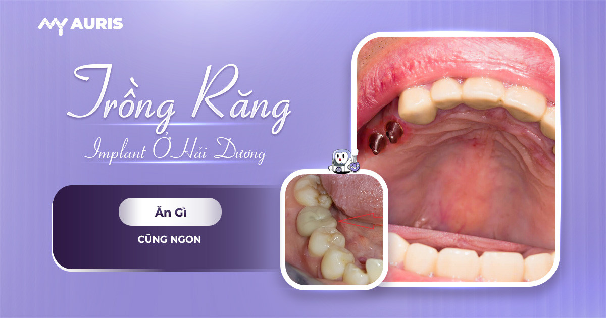 Trồng Răng Implant Tại Hải Dương