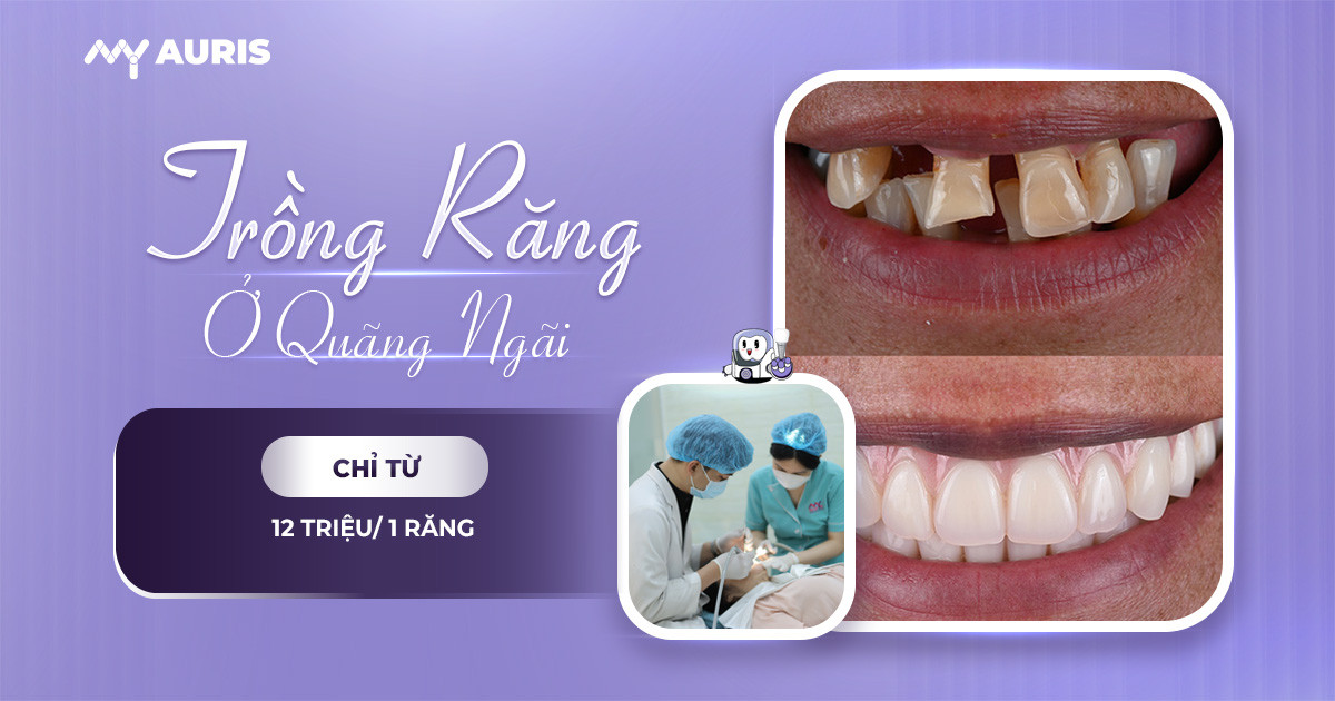 trồng răng implant ở Quảng Ngãi