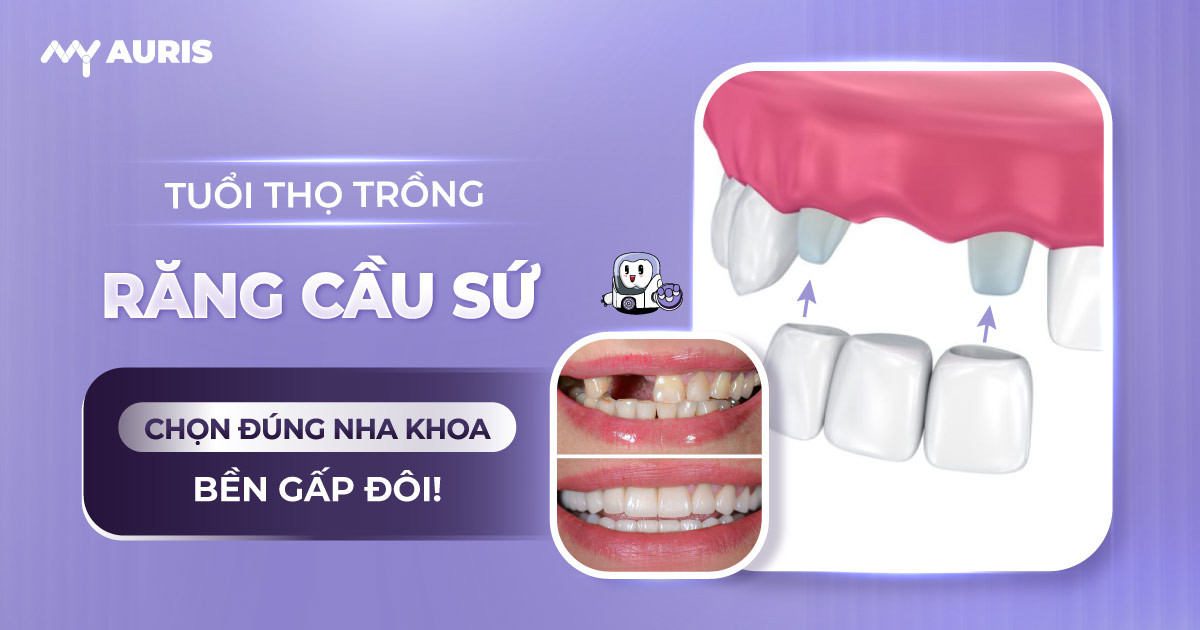 tuổi thọ trồng răng cầu sứ