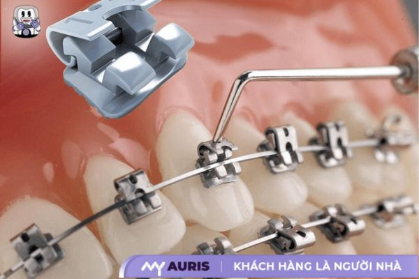 niềng răng mắc cài inox tự đóng