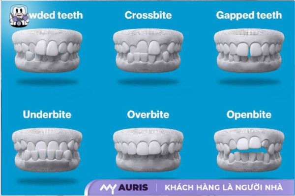 quy trình niềng răng invisalign