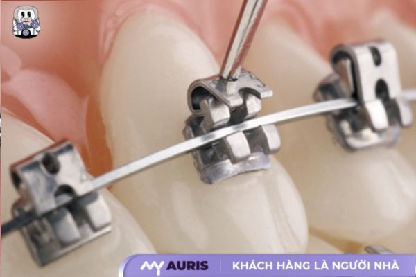 niềng răng mắc cài inox tự đóng