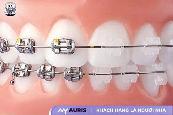 niềng răng mắc cài thông minh