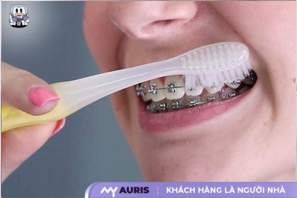 vệ sinh răng miệng khi niềng răng