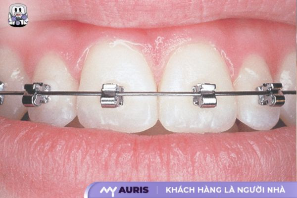 niềng răng mắc cài inox tự đóng