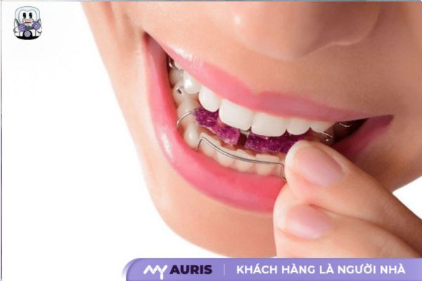 niềng răng tháo lắp kim loại cho người lớn
