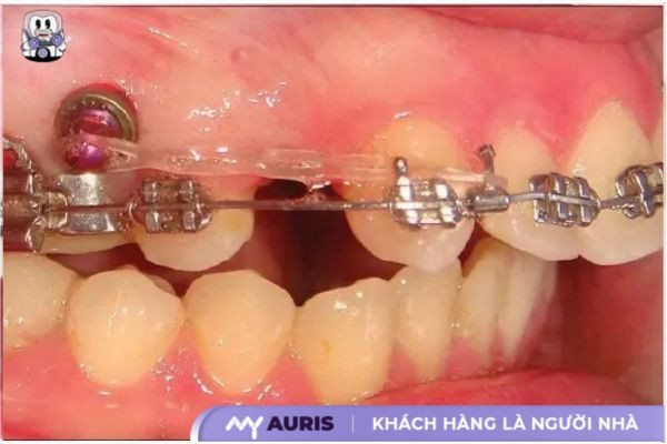 cắm vít niềng răng bị sưng