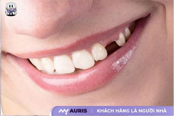 nhổ răng số 3 để niềng răng