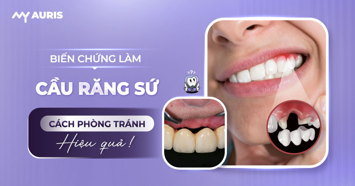 biến chứng làm cầu răng sứ