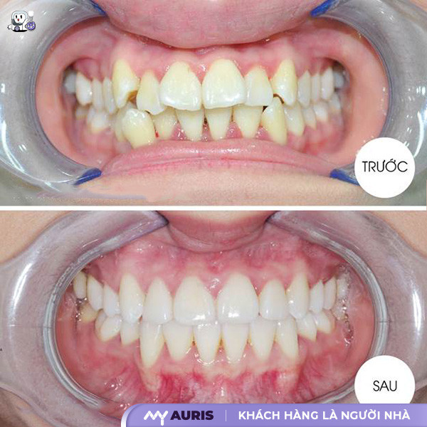 bọc sứ răng cửa bị lệch,bọc răng sứ cho răng cửa mọc lệch,bọc răng sứ răng cửa lệch