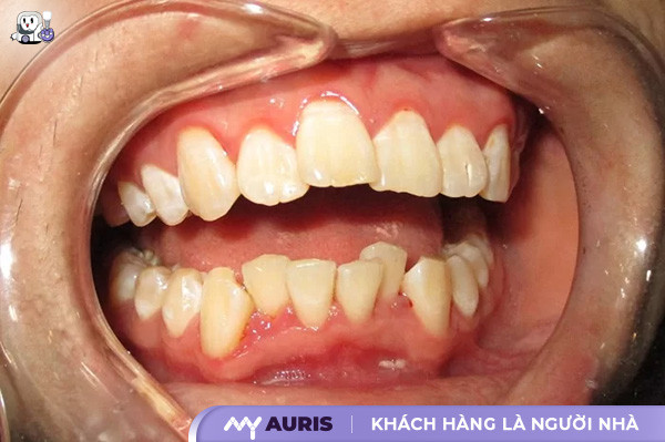bọc sứ răng cửa bị lệch,bọc răng sứ cho răng cửa mọc lệch,bọc răng sứ răng cửa lệch
