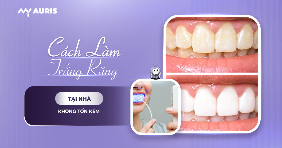 Cách làm trắng răng tại nhà