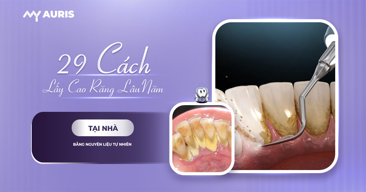 cách lấy cao răng lâu năm tại nhà