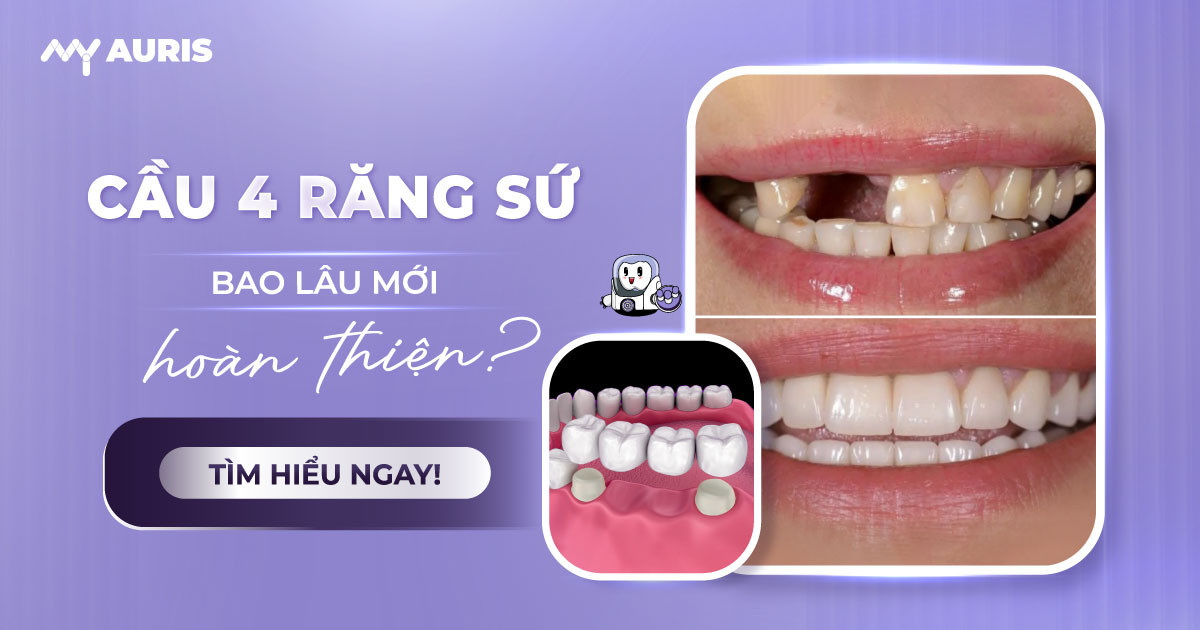 cầu 4 răng sứ bao lâu