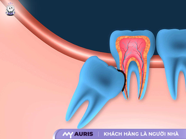 có nên nhổ răng khôn,có nên nhổ răng khôn không