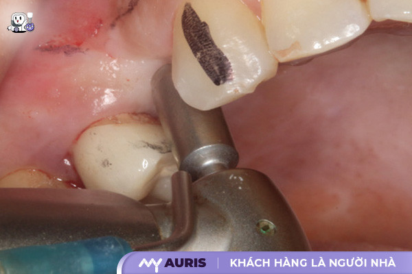 công nghệ trồng răng implant,có ai trồng răng implant chưa,công nghệ trồng răng implant không đau,công nghệ trồng răng mới,trồng răng công nghệ implant