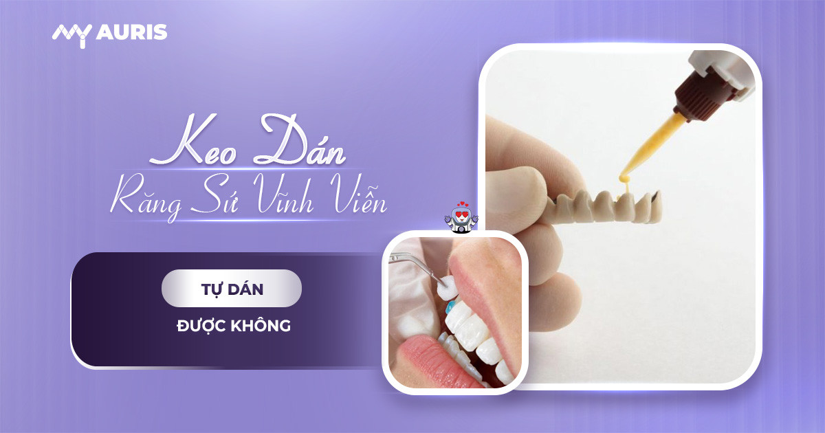 Keo dán răng sứ vĩnh viễn