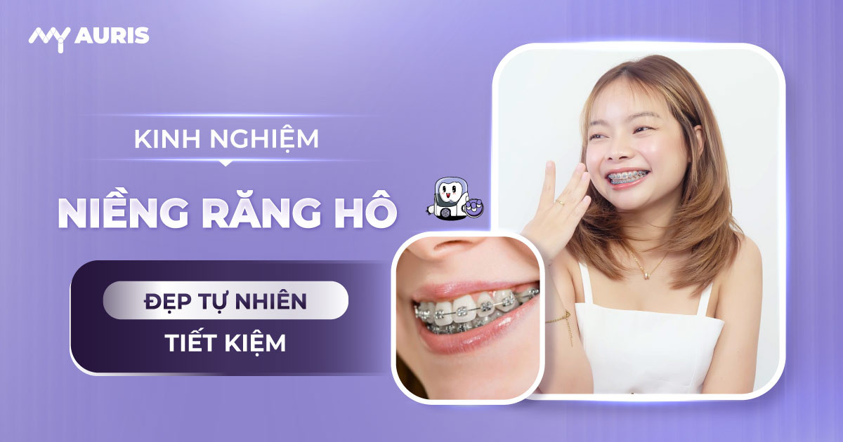 kinh nghiệm niềng răng hô