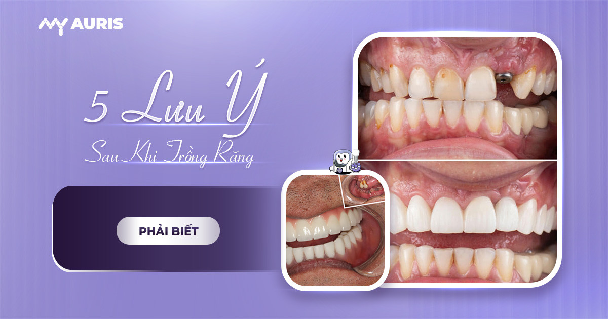 Lưu ý sau khi trồng răng implant