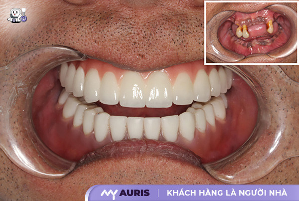 Lưu ý sau khi trồng răng implant