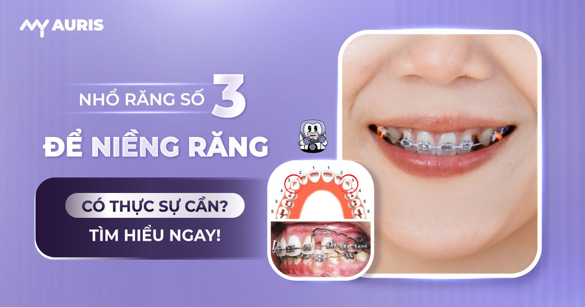 nhổ răng số 3 để niềng răng