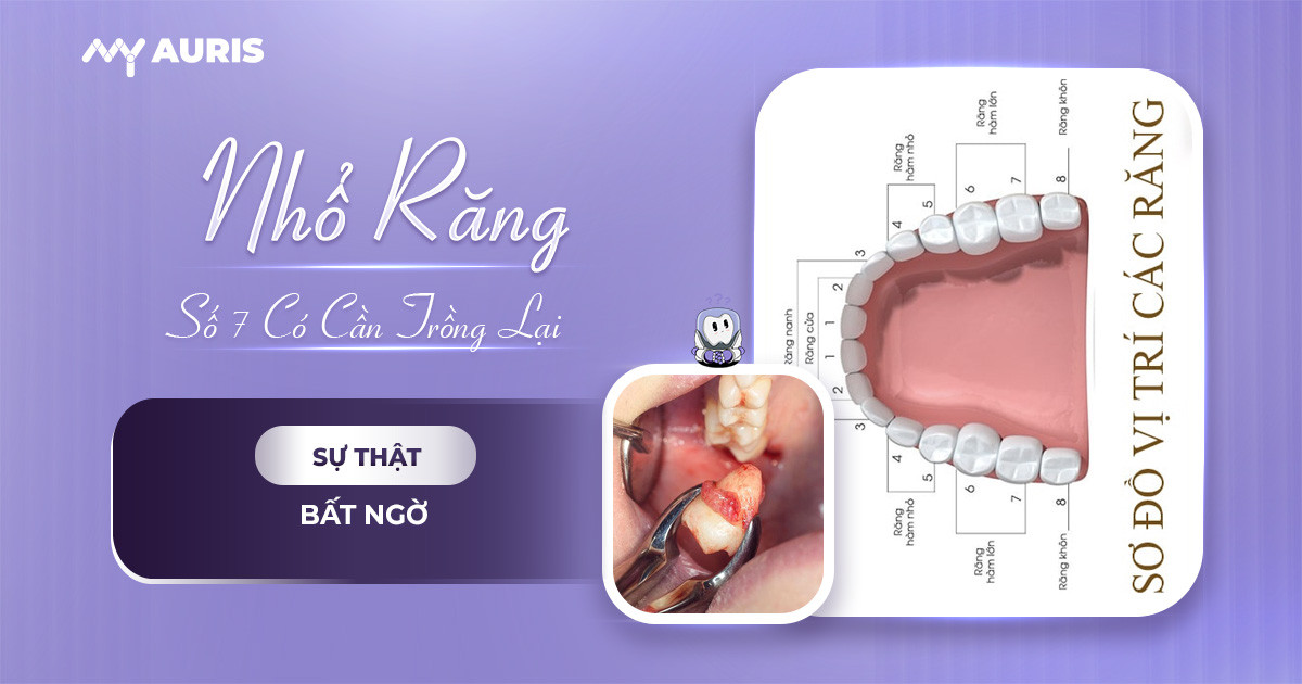 Nhổ răng số 7 có cần trồng lại không