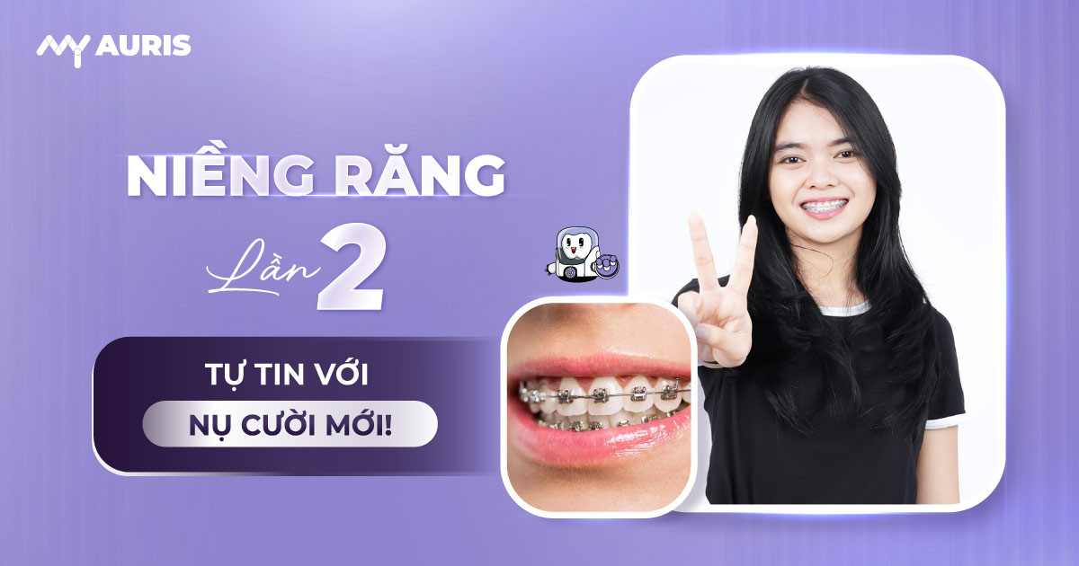 niềng răng lần 2