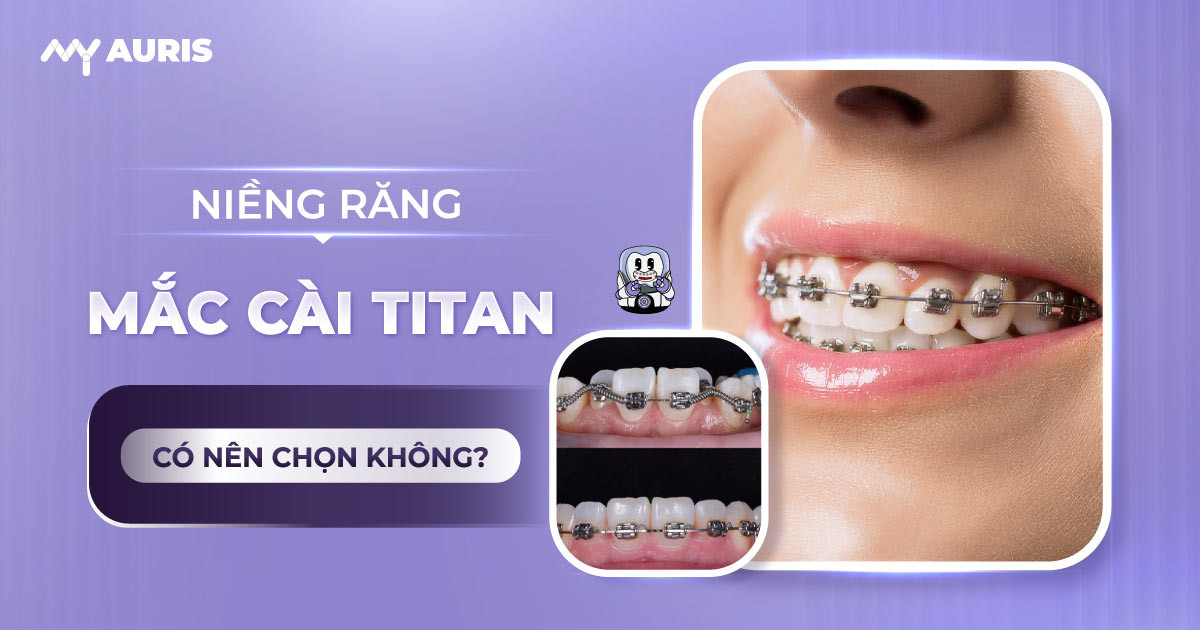 niềng răng mắc cài titan