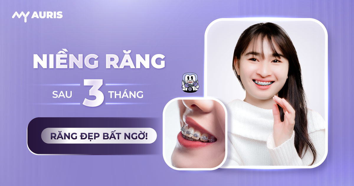 niềng răng sau 3 tháng