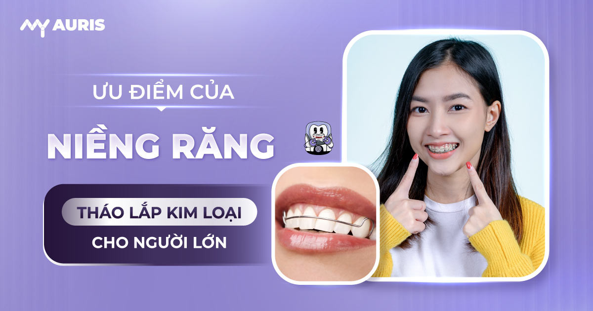 niềng răng tháo lắp kim loại cho người lớn