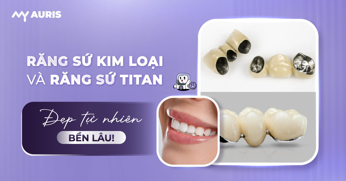 răng sứ kim loại và răng sứ titan