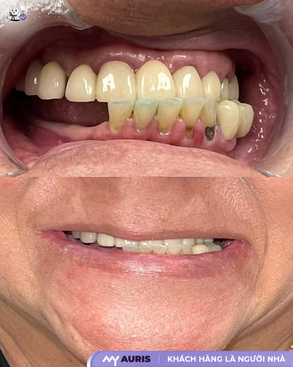 trồng răng hàm số 6 có đau không,trồng răng số 6 có đau không,trồng răng hàm đau không